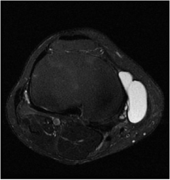 Meniscal cyst 1